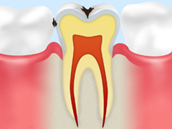一般虫歯治療