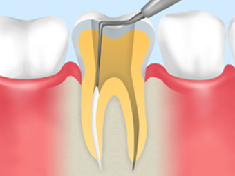 根管治療