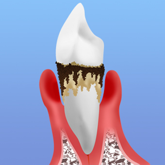 歯周病治療