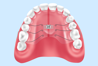 小児矯正（咬合誘導）