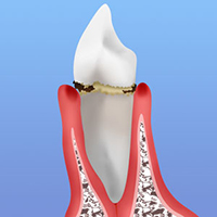 軽度の歯周炎