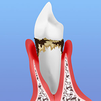 重度の歯周炎